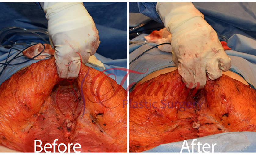 Tummy Tuck In Austin Texas